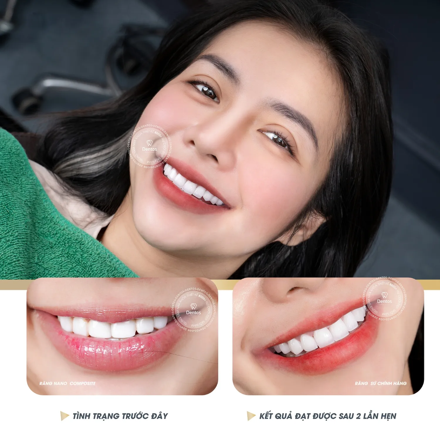 Nên bọc những răng lộ diện trên khuôn miệng khi cười lớn để tối ưu giá bọc răng sứ nguyên hàm